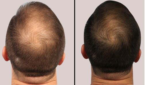 PRP Hair Therapy vs FUE Hair Transplant and cost in Delhi  Desmoderm